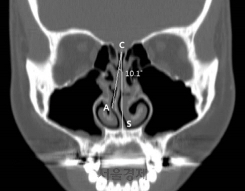 휘어진 코 칸막이뼈, 비대한 코 점막·편도…양압기 치료 실패율 높다