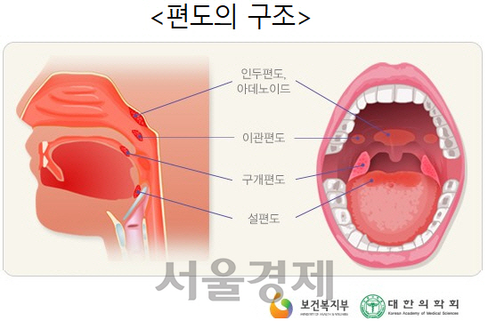 휘어진 코 칸막이뼈, 비대한 코 점막·편도…양압기 치료 실패율 높다