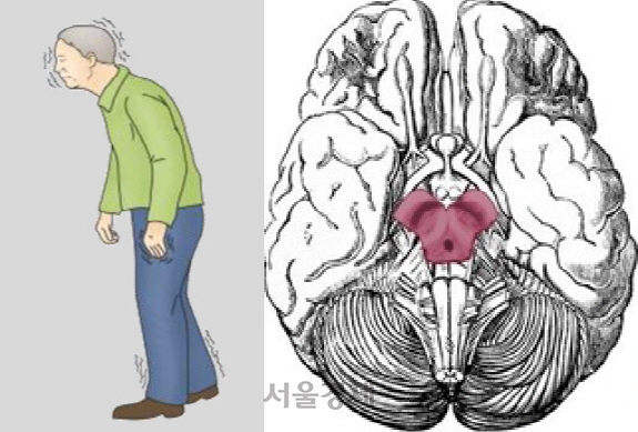 파킨슨병 환자는 고개·몸통이 앞으로 쏠려 몸이 구부정해지고 균형을 유지하기 힘들어진다. 오른쪽은 도파민 신경세포가 존재하는 중뇌. /그림제공=서울아산병원
