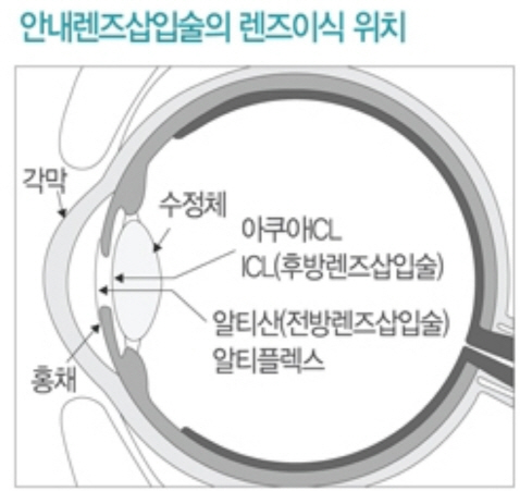 *출처: 누네안과병원