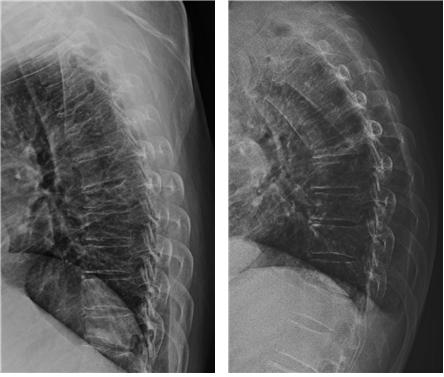 <흉추7번 압박골절이 진행되어 6개월 만에 척추 전만증이 진행된 환자의 X-ray 사진>
