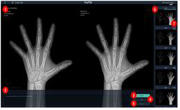 ‘뷰노메드 본에이지’는 환자의 뼈 엑스레이 패턴을 인식한 후 참조표준영상(남자 31개, 여자 27개)의 패턴과 유사성을 분석함으로써 환자의 뼈 나이를 자동으로 판독하는 인공지능(AI) 기반의 의료진단 소프트웨어다. /사진제공=식품의약품안전처