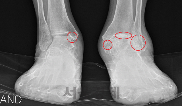 좌우 발목관절염 환자의 X-레이 사진. 오른발은 ‘ㄷ’자 모양 발목관절 안쪽이 무너져 뼈끼리 부딪치면서(빨간 원내) 통증을 느끼고 다리뼈가 바깥쪽으로 기울어져 있다. 왼발 발목은 관절의 안쪽·천장·바깥쪽 모두 무너져 있다. /사진제공=서울부민병원