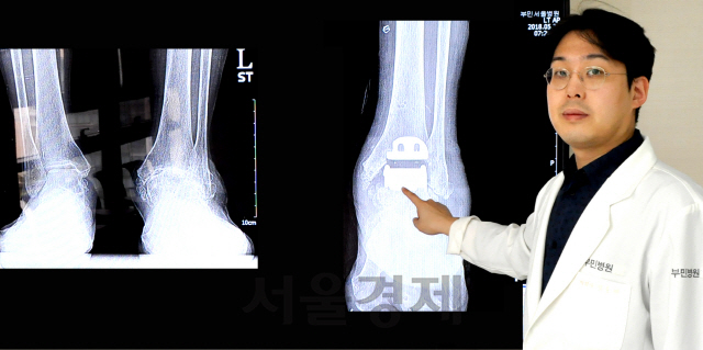 정훈재 서울부민병원장이 왼발 발목 인공관절 수술을 받은 환자의 수술 전(왼쪽)과 수술 후(오른쪽) X-레이 영상을 띄워놓고 수술 방법을 설명하고 있다. /사진제공=서울부민병원