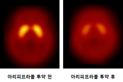 뇌를 라클로프라이드 양전자단층촬영(PET)한 영상