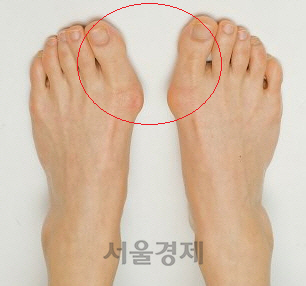무지외반증 환자의 발. 엄지 발가락이 새끼 발가락쪽으로 기울어져 통증을 느낀다.