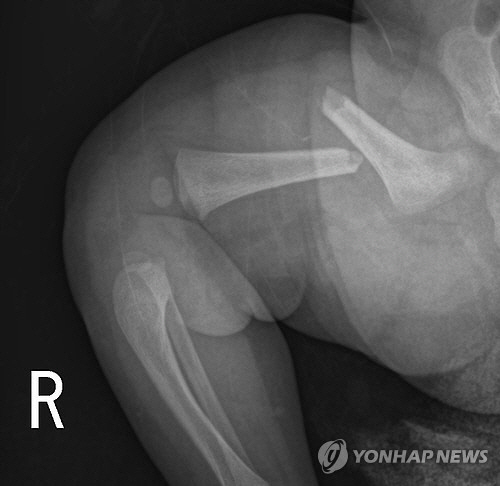 생후 50일 여아의 부러진 허벅지뼈 (사진=연합뉴스)