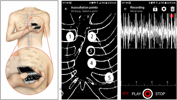 분당서울대병원과 카이스트 연구팀이 개발한 ‘모바일 앱’은 스마트폰 마이크로 심장 소리를 녹음하기 좋은 가슴 위치 5곳(가운데)을 알려주고 녹음이 잘 되고 있는 지 음파(오른쪽)도 보여준다.  /그림제공=분당서울대병원