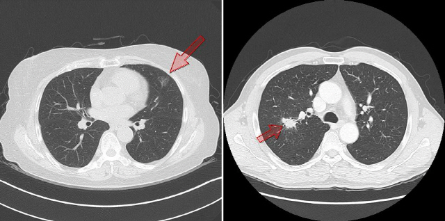 컴퓨터단층촬영(CT)영상에서 폐암 1기로 보이는 종양이라도 안개 낀 것처럼 보이는 ‘간유리 음영 폐암’(왼쪽 화살표)과 담배를 피워 생긴  선명한 비소세포 폐암의 종양은 모습도, 침투성도, 치료방법도 다르다. /사진제공=서울성모병원