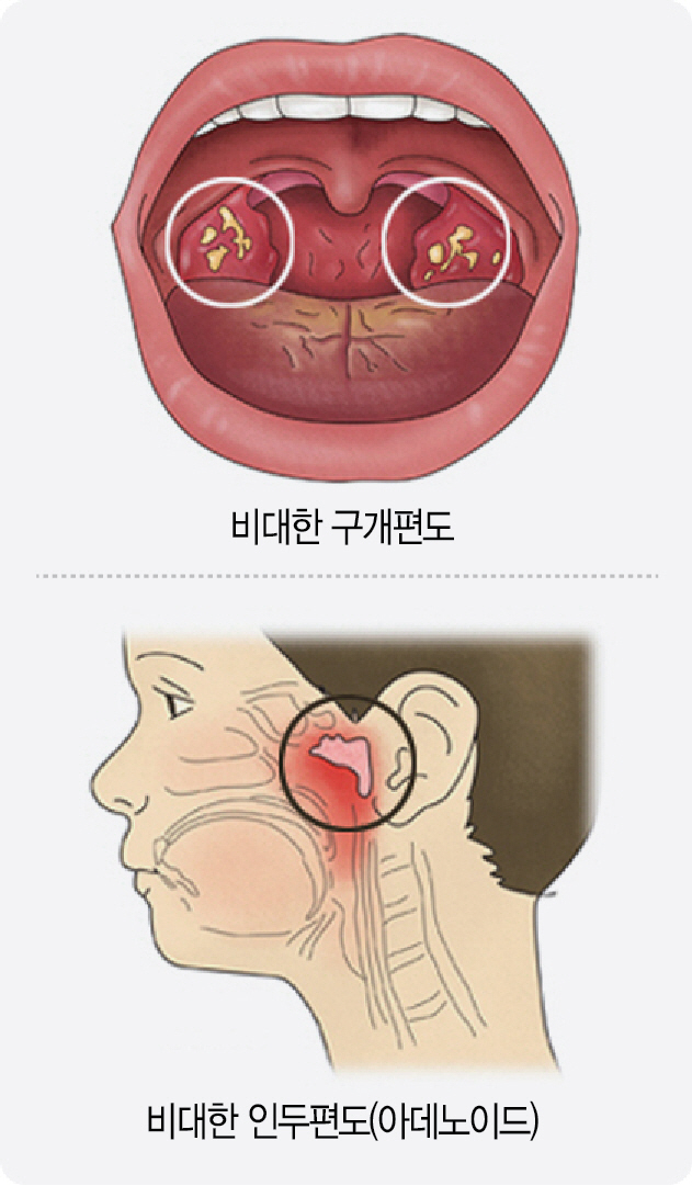 [아하! 건강상식]코골이 원인 연령층별 달라...어린이, 비대 편도가 숨길 막아