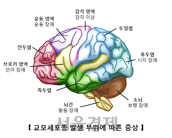 교포세포종 발생 부위에 따른 증상. /사진제공=서울아산병원