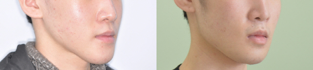 귀 밑 아래턱뼈 모서리(하악각) 부분을 과도하게 깎아 주걱턱이 된 A씨의 턱선(왼쪽)과 티타늄 보형물로 원래 모습을 복원한 후의 모습(오른쪽). /사진제공=서울대치과병원