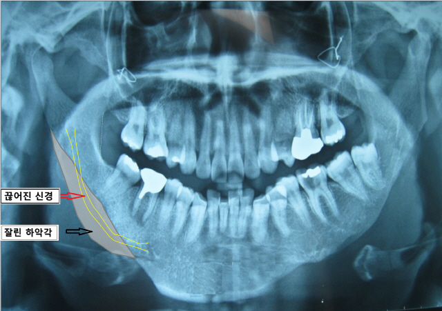 귀 밑 아래턱뼈의 모서리(하악각·회색) 부분을 너무 많이 잘라내 턱선이 너무 가팔라지고 아래잇몸 신경관이 끊어져 아래 치아·입술에 감각이상이 생긴 환자의 턱뼈 사진. /사진제공=최진영 교수