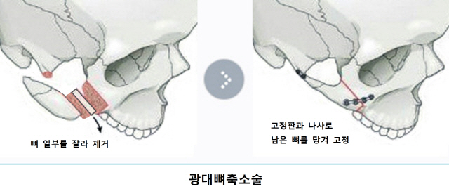 갸름해지려다 주걱턱 된 얼굴...티타늄 보형물로 되살린다