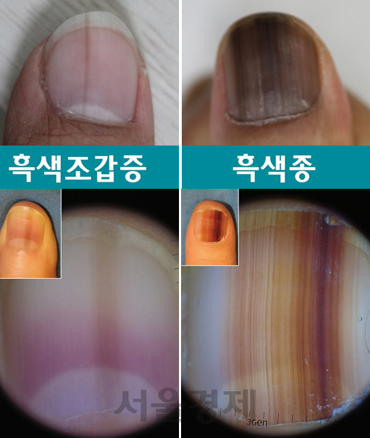 왼쪽 손톱은 세로 방향으로 폭 2㎜ 안팎의 밝은 갈색 띠가 보여 양성 흑색조갑증, 오른쪽은 폭 10㎜ 이상의 다색성(진한·연한 갈색) 색소침착과 비대칭·경계퇴색의 특징을 보여주는 흑색종 환자의 손톱.