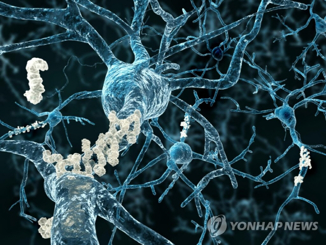 베타 아밀로이드 플라크가 형성된 알츠하이머 환자 뇌 신경. /게티이미지뱅크 제공=연합뉴스