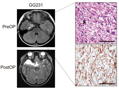 수술 전(PreOP)과 수술 후(PostOP) 신경절 교세포 종 자기공명영상(MRI) 사진과 이형성 동반 신경세포 병리 조직.