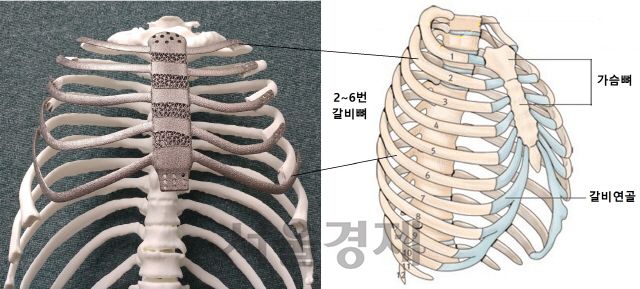 인공 가슴뼈와 2~6번 갈비뼈의 절반가량을 3D 프린팅 방식으로 만든 티타늄 인공뼈를 환자의 남은 갈비뼈와 고정한 모습(왼쪽)과 가슴·갈비뼈의 전체 구조(오른쪽).