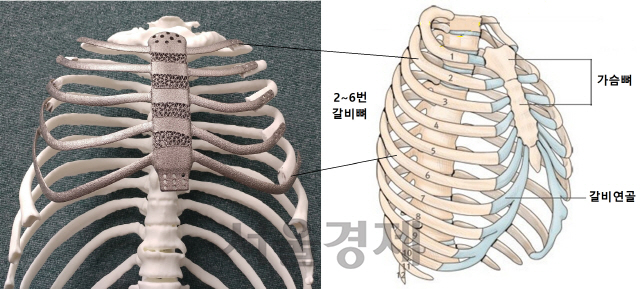 국내 첫 3D 프린팅 가슴·갈비뼈 이식수술 성공