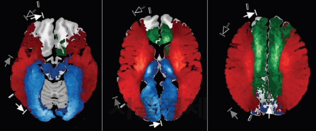 고해상도 뇌혈류지도. 빨간색은 중간 대뇌동맥, 녹색은 앞 대뇌동맥, 파란색은 뒤 대뇌동맥이 혈전으로 막혔을 때 뇌경색이 발생하는 부위다. /사진제공=동국대 일산병원