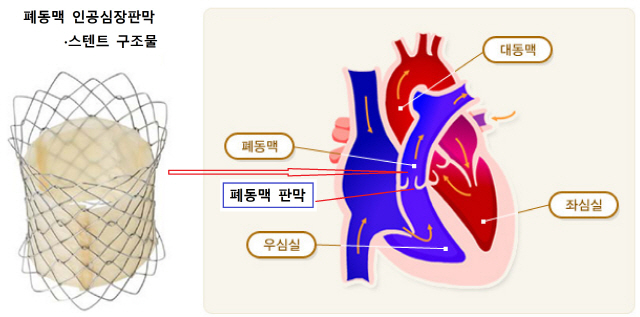 한국산 폐동맥 인공심장판막·스텐트 일 낸다