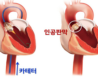 한국산 폐동맥 인공심장판막·스텐트 일 낸다