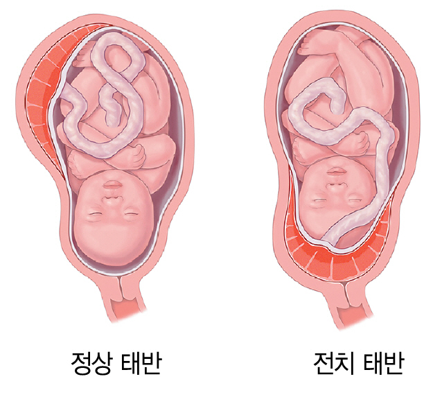 임신 중기 '전치태반 신생아' 호흡곤란증후군 위험 4.6배 높아