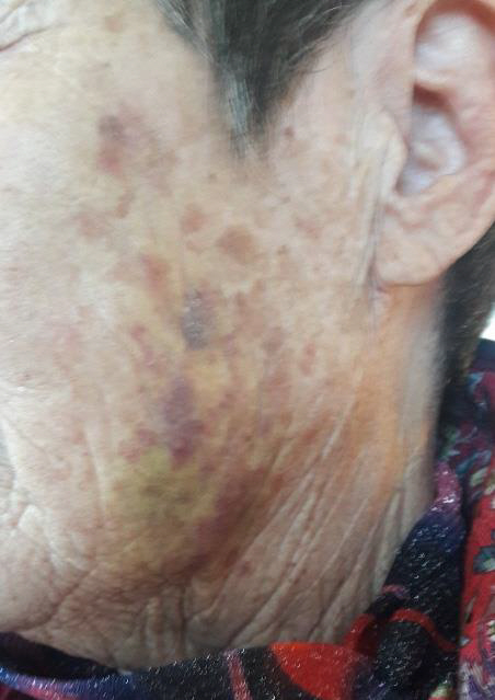 요양보호사가 가한 폭행으로 치매 할머니 얼굴에 멍 자국이 선명하게 남았다./피해자 가족 제공