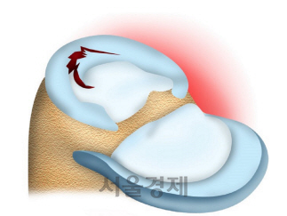 손상된 연골판 이미지