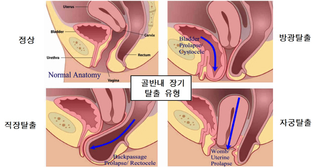 성인 여성 30%, 골반바닥근육 등 손상·노화로 방광·직장·자궁 '싱크홀'