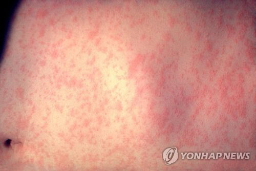 안양서 홍역 확진 환자 발생…경기도, 확산 차단 대책 마련