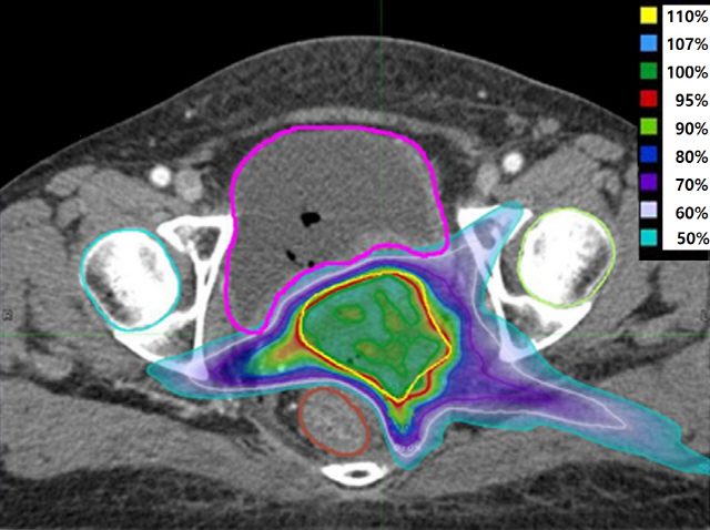 자궁경부암 재발 환자에게 맞춤형으로 세기조절방사선치료(IMRT)를 하기 위한 시뮬레이션 영상. 불규칙한 종양의 모양과 부위에 따라 방사선 조사 범위와 세기를 달리할 수 있다.