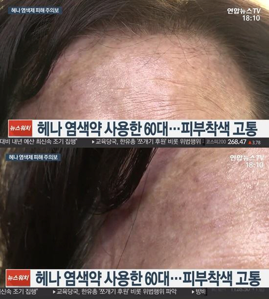 헤나염색 부작용 이 정도야? ”약 피부에 닿으면 검게 타버리는 듯” 영구 흉터에 심하면 응급실