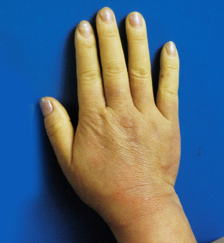 말초혈관이 비정상적으로 수축해 손이 하얗게 변한(레이노 현상) 손. 냉증과 손발저림·통증의 원인이 된다. /사진제공=분당서울대병원