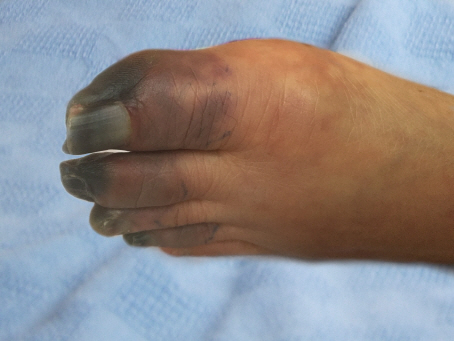 말초혈관이 막혀 손발가락 괴사까지 초래하는 버거씨병 환자의 발. /사진제공=분당서울대병원