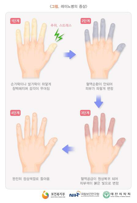 레이노 증후군 증상/질병관리본부 국립보건연구원 제공