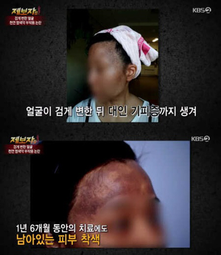 헤나염색 부작용 이 정도야? 검은 색소 목까지 내려와 “3년 치료” 염모제 패치테스트 필수