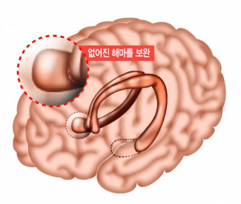 뇌 일부를 절제해도 기억력을 유지할 수 있다는 연구결과가 발표됐다./서울대병원 제공