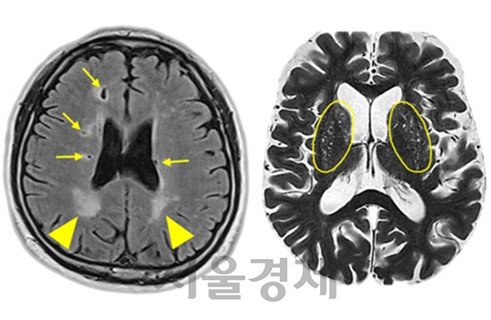 뇌백질 고신호 병변(왼쪽 사진 화살촉), 열공성 뇌경색(왼쪽 사진 화살표), 확장성 혈관주위 공간(오른쪽 사진의 좌우 타원 안쪽 흰 점들) 등 여러 소혈관질환이 함께 관찰돼 뇌경색 위험이 높은 사람의 뇌 자기공명영상(MRI). /사진제공=서울시보라매병원