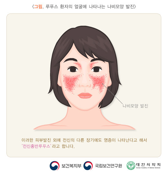 루프스병 증상은? 붓고 발진 구강궤양, 신장 망가져 일상 생활X “친구에게 이식 받은 스타”