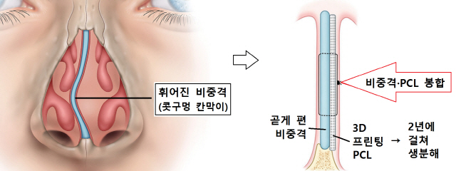 심하게 휘어진 비중격 연골을 곧게 편 뒤 생분해성 3D 프린팅 임플란트와 봉합하는 교정술의 개념도.