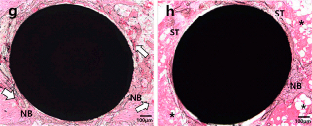 당뇨 쥐의 잇몸뼈에 임플란트(검은색 타원)를 하고  2주 뒤 찍은 현미경 사진. 혈관·뼈 형성을 촉진하는 HIF-1α 겔을 바른 뒤 심은 임플란트 주변(왼쪽 g)에는 적혈구가 많은 혈관(흰색 화살표)들과 새로 만들어진 뼈를 볼 수 있다. 반면 HIF-1α 젤을 바르지 않고 심은 임플란트 주변(오른쪽 h)에는 섬유아세포와 지방조직(*표)이 많고 새로 만들어진 뼈의 두께와 양이 적다.