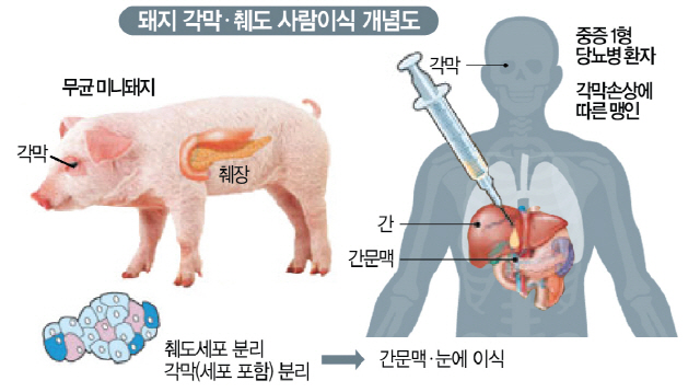 무균 돼지 생각막·췌도 사람 이식 첫 임상 눈앞...시력 살리고 혈당조절 가능할까