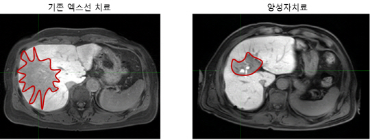 간세포암 환자를 X선과 양성자빔으로 치료하는 과정에서 손상된 간 부위(빨간선 내 짙은 회색 부분). 양성자치료 때 손상 범위가 훨씬 적다.