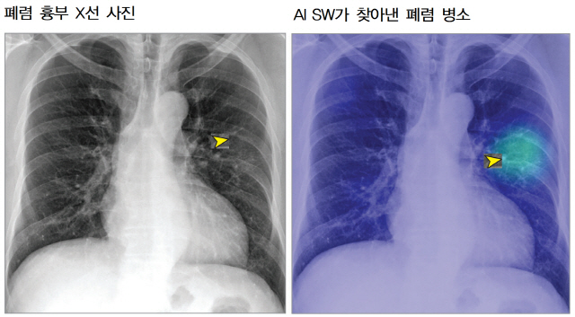 흉부 X선 사진(왼쪽)에서는 폐렴 병소가 잘 안 보여 15명의 의사 모두 놓쳤다. 반면 인공지능 소프트웨어(AI SW)는 폐렴 병소(오른쪽 노란 화살촉 부분)를 특정해 보여준다. /사진제공=서울대병원