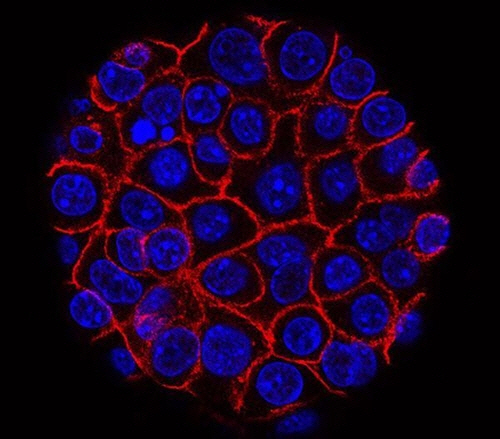 막(붉은색)으로 둘러싸여 커진 췌장암 세포들. /출처=미국 국립암연구소