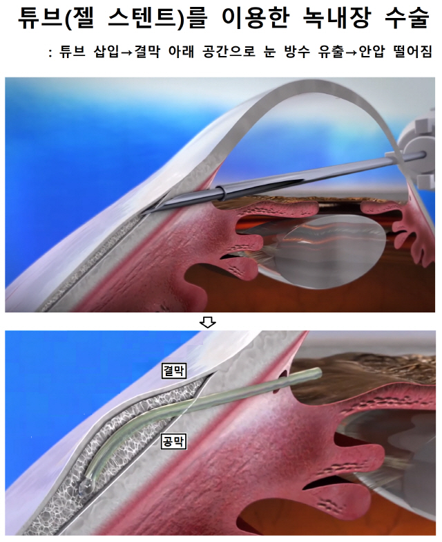 튜브(젤 스텐트)를 이용한 녹내장 수술 : 튜브 삽입→ 결막 아래 공간으로 눈 방수 유출→ 안압 떨어짐  결막 공막