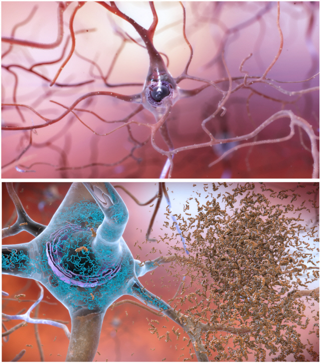 정상적인 뇌 신경세포(위)와 알츠하이머병·알츠하이머 치매가 진행 중인 병든 신경세포(아래). 병든 신경세포 내부에 축적된 타우단백질(파란색)이 신경섬유 엉킴을 초래하고 세포 돌기에 베타-아밀로이드 단백질 플라크가 잔뜩 엉겨붙어 세포들이 서서히 죽어간다. /이미지=미국 국립노화연구소(NIA)