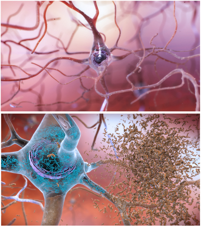 정상적인 뇌 신경세포(위)와 알츠하이머병·알츠하이머 치매가 진행 중인 병든 신경세포(아래). 병든 신경세포 내부에 축적된 타우단백질(파란색)이 신경섬유 엉킴을 초래하고 세포 돌기에 아밀로이드-베타 단백질들이 잔뜩 엉겨붙어 세포들이 서서히 죽어간다. /이미지=미국 국립노화연구소(NIA)