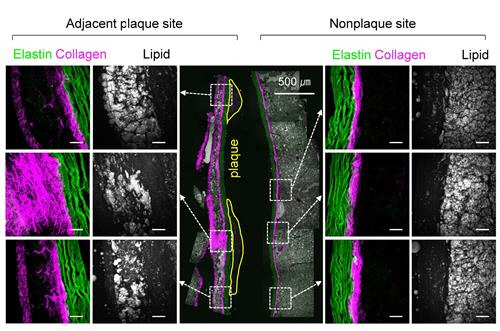 동맥경화 플라크(plaque)에 인접한 혈관 외벽(왼쪽)은 콜라겐(보라색)이 확장해 섬유화됐고 비정상적인 지방 모양도 보인다. 반면 동맥경화 플라크가 없는 혈관 외벽(오른쪽)은 깨끗하다. /사진=KRISS